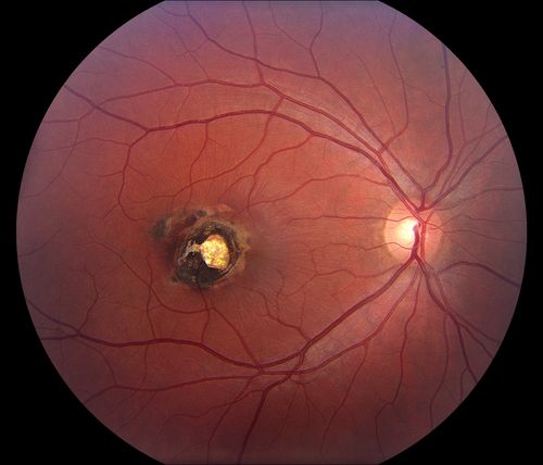 Chorioretinal Scar
21 year old male with a chorioretinal scar OD
Keywords: chorioretinal;scar