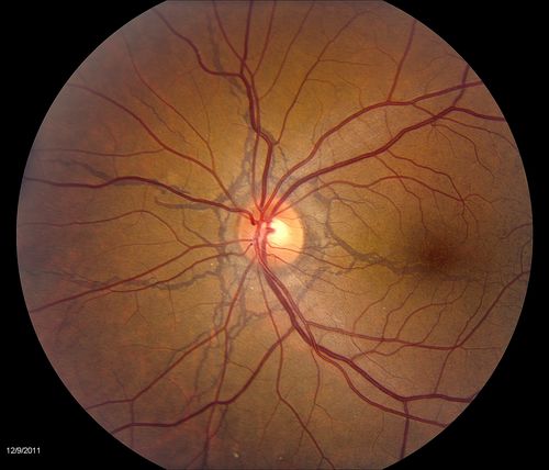 PXE with Angioid Streaks
PXE with angioid streaks OS (12/09/2011)
Keywords: Angioid;Streaks;august2012