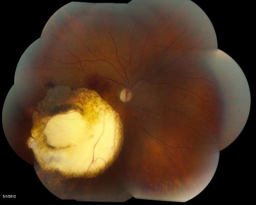 Choroidal Malignant Melanoma - Montage
Choroidal malignant melanoma status post plaque radiotherapy OD in 1986, patient also has a submacular hemorrhage OD, and radiation retinopathy OD.
Keywords: Choroidal;Malignant;Melanoma;submacular;hemorrhage;retinopathy