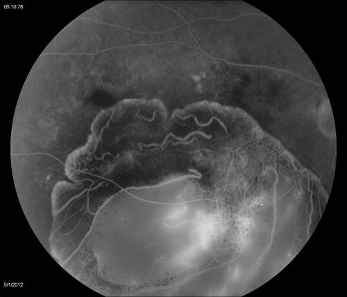 Choroidal Malignant Melanoma - mid phase FA
mid-phase of FA at 5 minutes 10 seconds  (Choroidal malignant melanoma status post plaque radiotherapy OD in 1986, patient also has a submacular hemorrhage OD, and radiation retinopathy OD.)
Keywords: Choroidal;Malignant;Melanoma;submacular;hemorrhage;retinopathy