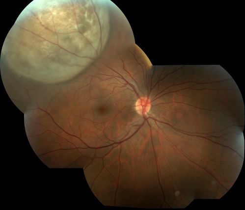 Melanoma
40 Year old male
Keywords: april2012