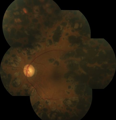 Extensive PRP scarring
64 year old male with extensive PRP scarring due to diabetic retinopathy.
