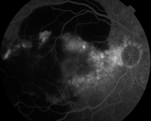 75 year old male seen for ARMD. Pt developed massive hemorrhage with lipid and macular edema.
