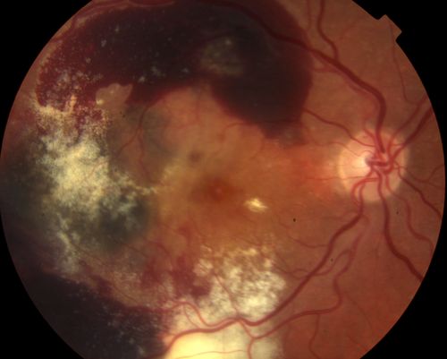 75 year old male seen for ARMD. Pt developed massive hemorrhage with lipid and macular edema.

