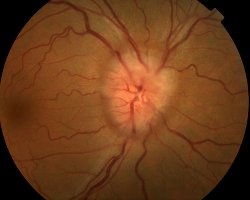 Optic disc swelling
56 year old woman
