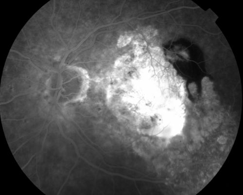 87 year old male seen for neovascular macular degeneration. Patient had huge disciform scar and lipid.
