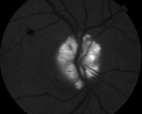 51 year old female with optic disc drusen. When taking the photo with autofluress the areas of optic disc drusen were very apparent.
