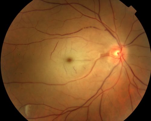 Central Retinal Artery Occlusion
60 year old male with LP vision due to extensive blood flow loss.
Keywords: april2012