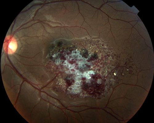 CAVERNOUS HEMONGIOMA
28 year old male w/ 20/200 vision at time of exam.  Patient c/o poor vision since childhood.  No significant medical history or family medical history.  A problem was only noted when patient enlisted in the Army.
Keywords: april2012