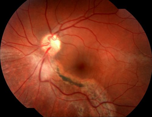 23 yr old w/ chronic RD and sub retinal fibrosis.  Also has a h/o scleral buckle removal
