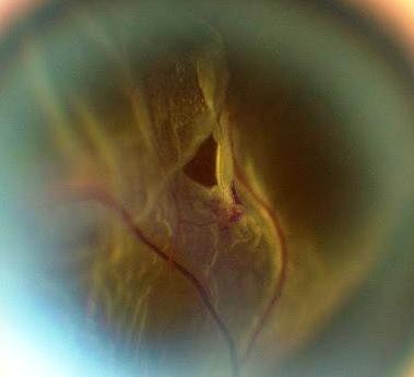 Retinal Tear
Keywords: Retinal Detachment