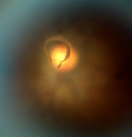 PVD with Weiss Ring /Optic Nerve in Background
Keywords: branch retinal vein occlusion;floater