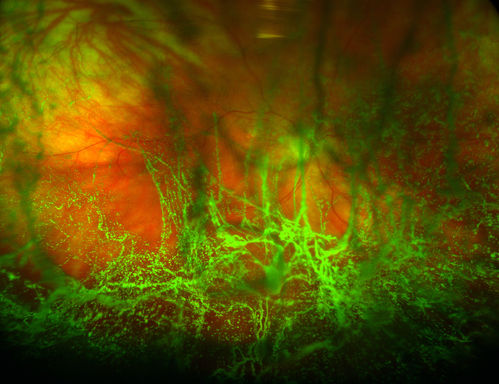 Asteroid Hyalosis
Diabetic patient for annual eye exam. No exudates or hemorrhages visible. asteroid hyalosis visible in the right eye. No other visual complaints.
