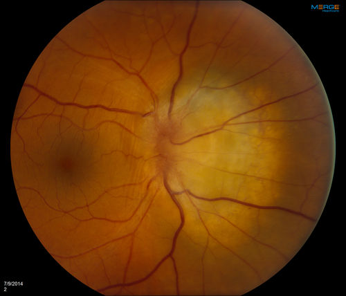 Melanoma of Optic Nerve
Patient comes in for evaluation on Optic Nerve Melanoma in the right eye. Patient's VA is 20/40 in the right eye. Fundus photograph reveals melanoma invading optic nerve and ultrasound reveals behind the optic nerve as well. 
Keywords: july2014