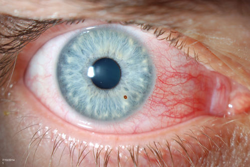 Corneal Foreign Body
Patient was cutting tile and debris flew in his eyes. Patient complained of discomfort and redness in the right eye. VA is 20/20 in the right eye. Slit lamp photography shows foreign body inferior nasal in the right eye. Removed foreign body and patched with antibiotic and will be re examined the next day. 
