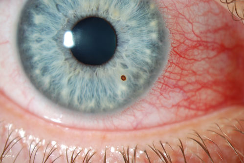 Corneal Foreign Body
Patient was cutting tile and debris flew in his eyes. Patient complained of discomfort and redness in the right eye. VA is 20/20 in the right eye. Slit lamp photography shows foreign body inferior nasal in the right eye. Removed foreign body and patched with antibiotic and will be re examined the next day. 
