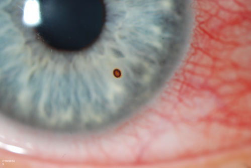 Corneal Foreign Body
Patient was cutting tile and debris flew in his eyes. Patient complained of discomfort and redness in the right eye. VA is 20/20 in the right eye. Slit lamp photography shows foreign body inferior nasal in the right eye. Removed foreign body and patched with antibiotic and will be re examined the next day. 
