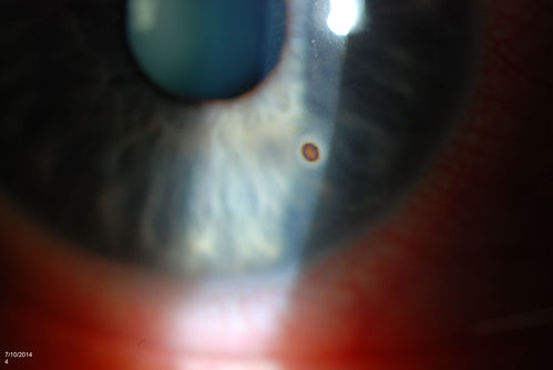 Corneal Foreign Body
Patient was cutting tile and debris flew in his eyes. Patient complained of discomfort and redness in the right eye. VA is 20/20 in the right eye. Slit lamp photography shows foreign body inferior nasal in the right eye. Removed foreign body and patched with antibiotic and will be re examined the next day. 
