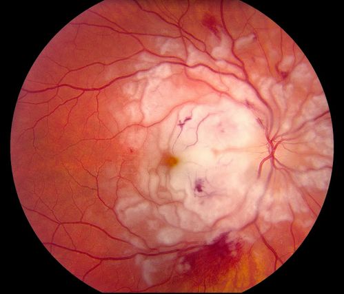 Purtscher's Retinopathy
19 year old female after pregnancy
