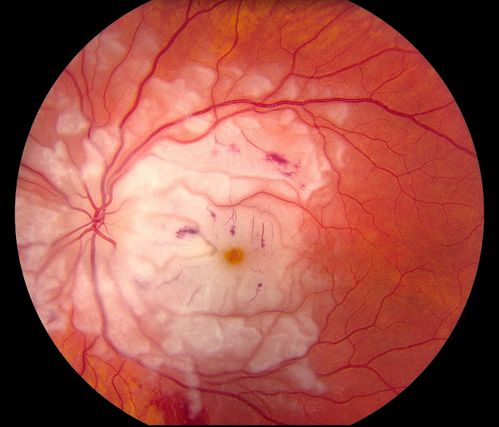 Purtscher's Retinopathy
19 year old female after pregnancy
