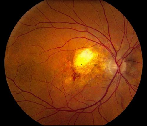 Pseudoxanthoma Elasticum with CNV
Schlüsselwörter: macular degeneration