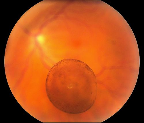 Floating Vitreous Cyst
Floating Vitreous Cyst
Keywords: floaters;june2012