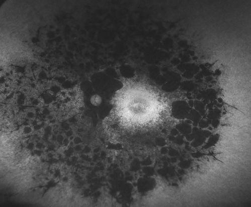 Retinitis Pigmentosa
Patient comes in with cloudy vision. VA is 20/200 in both eyes. Patient has had retinal pigmentosa since 1986. Patient to consider cataract surgery to help her visual symptoms...
