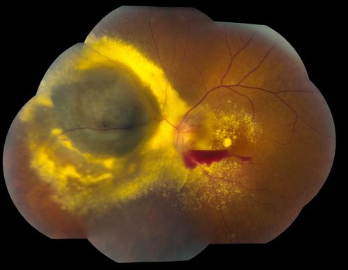 Choroidal Melanoma
Post op Radioactive Implant with hard exudates surrounding the Melanoma with hemorrhage present. 
