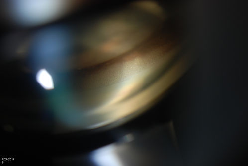 Silicone Oil Bubbles in the Angle
Patient is evaluated for glaucoma associated with ocular inflammation. VA is CF in the right eye and 20/50, left eye. Gonioscopy photos shows little silicone oil bubbles in the inferior angle of the right eye. Patient to consider removal of silicone oil. 
