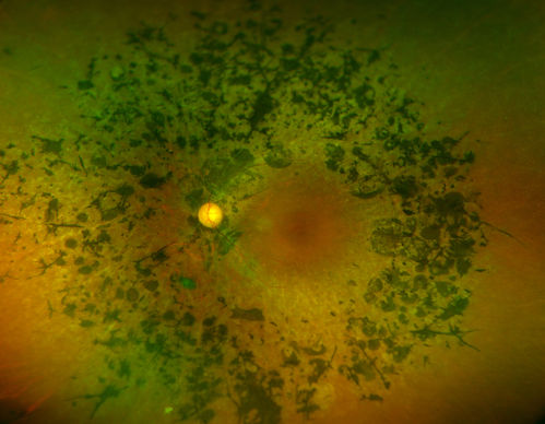Retinitis Pigmentosa
Patient comes in with cloudy vision. VA is 20/200 in both eyes. Patient has had retinal pigmentosa since 1986. Patient to consider cataract surgery to help her visual symptoms...
Keywords: august2014