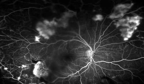 Fluorescence Angiography of BDR
Patient is here for eval on diabetic retinopathy. FA photos show significant diabetic retinopathy with hemorrhage inferior temporal to the optic nerve. 

