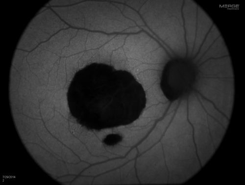 Macular Scar
Fundus photography with Auto Fluorescent shows macular scar centrally, right eye. VA is 20/200 in the right eye. 
