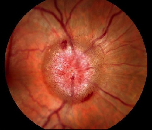 Swollen Nerve with Hemorraghe
Keywords: papilledema;june2012