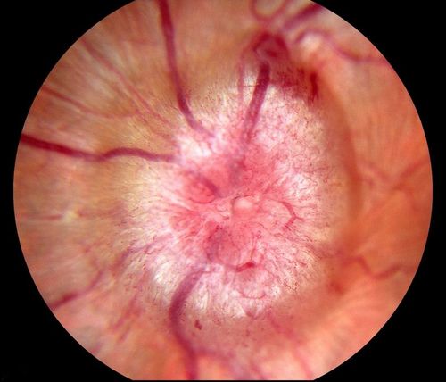 Swollen Nerve with Hemorraghe
Keywords: papilledema