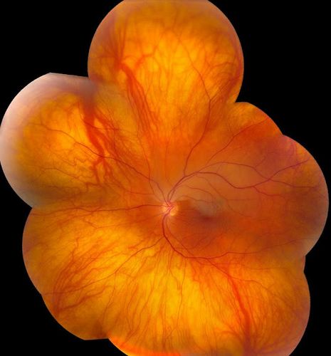 Montage of Hemi-Central Retinal Artery Occlusion
Keywords: crao