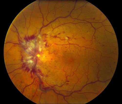 Central Retinal Vein Occlusion
Keywords: november2012