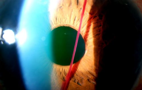 Blood Strand through Anterior Chamber
