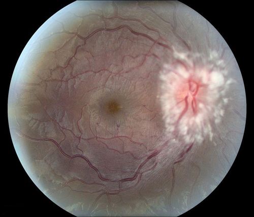 Swollen Nerve
Keywords: papilledema