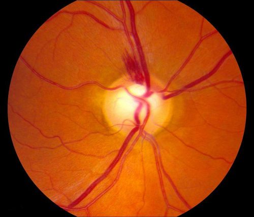 Optic Nerve with Hemorrhage
Keywords: hemorrhage