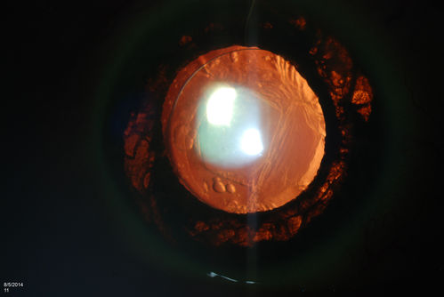 Trans-Illumination Defect with Fuch's Dystrophy.
Patient comes in for eval on post cataract surgery. VA is 20/30 both eyes. Slit lamp exam shows Fuch's Dystrophy on the cornea on the right eye. IOL haptics are chaffing the iris therefore producing trans illumination defect in the right eye. 
