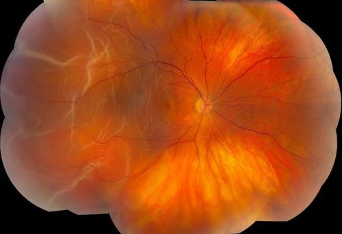 Retinal Detachment
Keywords: Retinal Detachment
