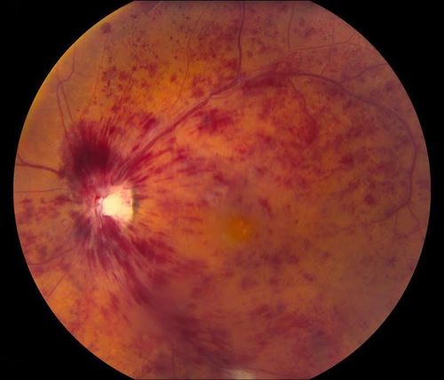 Central Retinal Vein Occlusion
