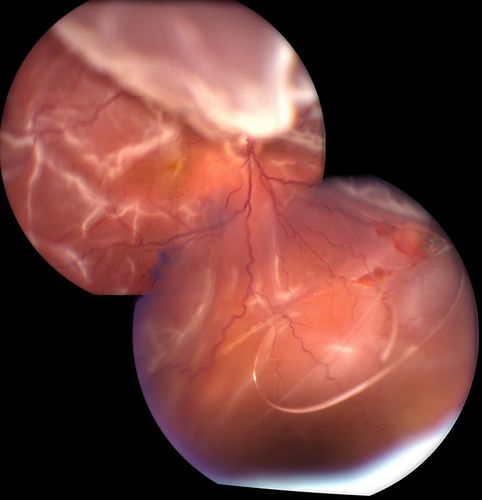 Retinal Detachment with Dislocated IOL Lens
47-year old male who had trauma to the right eye. Patient had retinal detachment surgery in the past (Scleral Buckle), to the right eye. Patient came in with another retinal detachment with dislocated PC IOL lens. Notice the haptics tearing the retina. Patient underwent vitrectomy with gas exchange. VA was hand motion 1-day post op.
