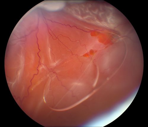 Retinal Detachment with Dislocated IOL Lens
47-year old male who had trauma to the right eye. Patient had retinal detachment surgery in the past (Scleral Buckle), to the right eye. Patient came in with another retinal detachment with dislocated PC IOL lens. Notice the haptics tearing the retina. Patient underwent vitrectomy with gas exchange. VA was hand motion 1-day post op.
Keywords: november2012
