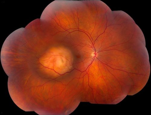 Choroidal Melanoma
