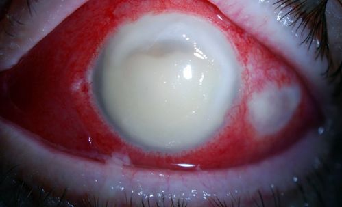 Endophthalmitis with Hypopion
