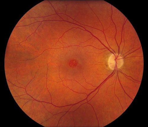 Macular Hole
Keywords: macular hole