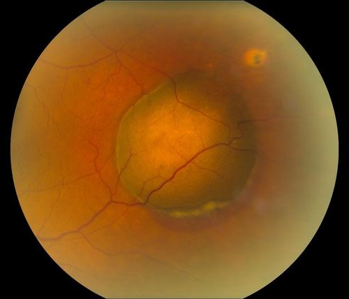 Choroidal Melanoma
