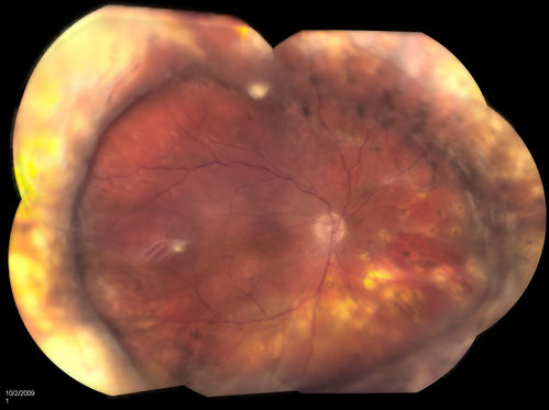 Retinal Detachment with Dislocated IOL Lens
47-year old male who had trauma to the right eye. Patient had retinal detachment surgery in the past (Scleral Buckle), to the right eye. Patient came in with another retinal detachment with dislocated PC IOL lens. Notice the haptics tearing the retina. Patient underwent vitrectomy with gas exchange. VA was hand motion 1-day post op.
