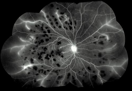 Retinal Vasculitis due to Lupus (FA)
Systemic Lupus Erythematosis - Vasculitis
